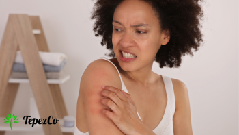 How to care for skin with eczema?